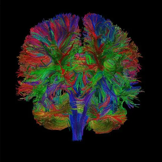 MRI Brain With Diffusion